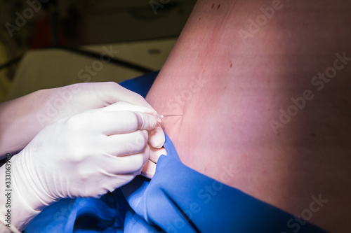 Close up image of a doctor performing a epidural spinal block for a pregnant woman