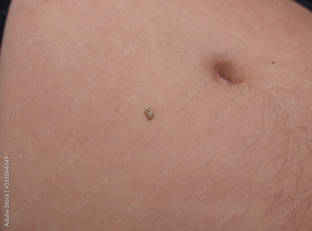 5 mm kidney stone laying on naked belly 5 mm kidney stone laying on naked belly