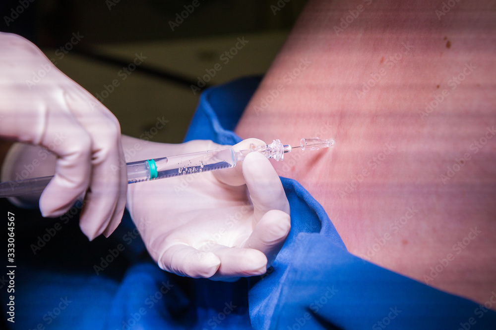 Close up image of a doctor performing a epidural spinal block for a pregnant woman Close up image of a doctor performing a epidural spinal block for a pregnant woman