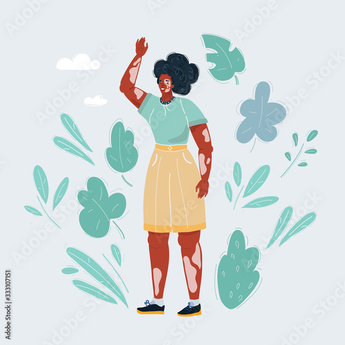 Vector illustration of Vitiligo woman on white background.