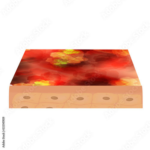 Cyst acne. furuncle Acne on the skin cysts and pimples. Dermatological and cosmetic inflammatory diseases on the skin of the face. Infographics. Vector illustration on isolated background.