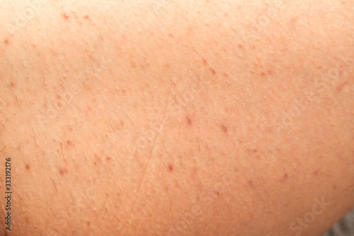 Folliculitis on skin - hormonal imbalance