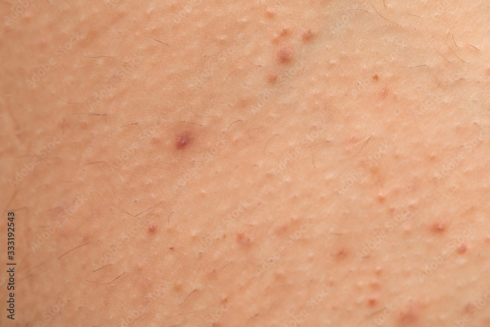 Folliculitis on skin - hormonal imbalance Folliculitis on skin - hormonal imbalance