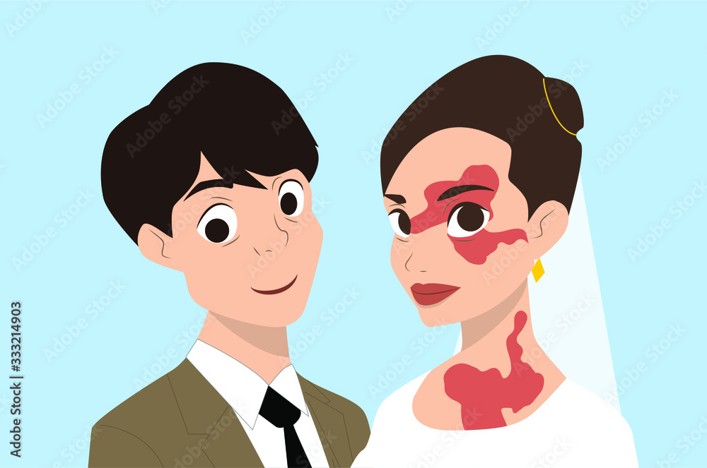 Bride and groom with the skin disease vitiligo. Flat vector illustration. EPS 10. Bride and groom with the skin disease vitiligo. Flat vector illustration. EPS 10.