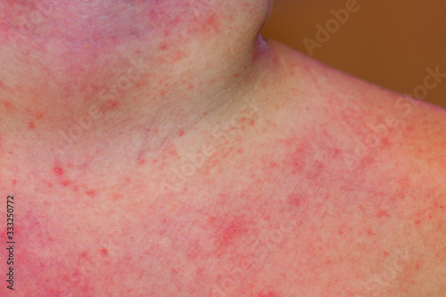 A child with severe heat rash on his neck and chest coused by warm and humid summer.