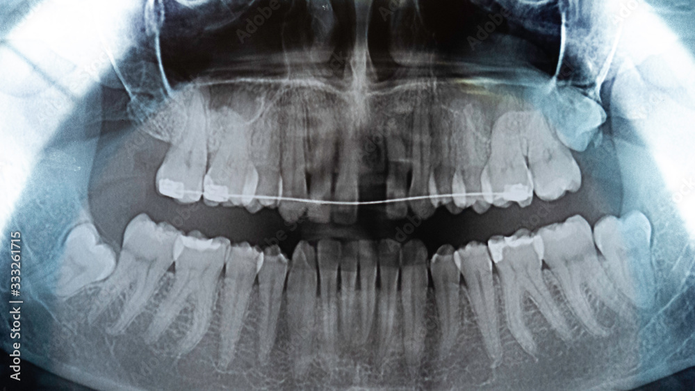 Original black and white x-ray teeth scan. Upper teeth with dental ...