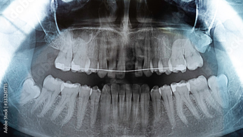 Original black and white x-ray teeth scan. Upper teeth with dental brace.