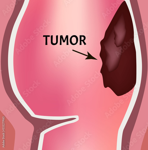 A tumor in the rectum. The structure of the rectum of the intestine. Types of polyps and tumors in the colon. Infographics. Vector illustration on isolated background.