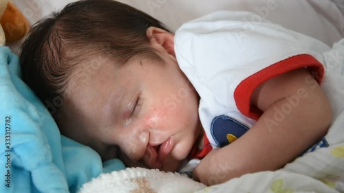 Baby with Cleft lip and cleft palate