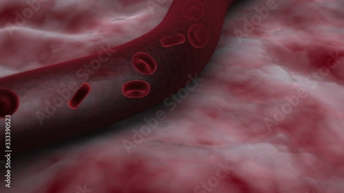 Biomedical animation of a hemorrhagic stroke in the human brain.