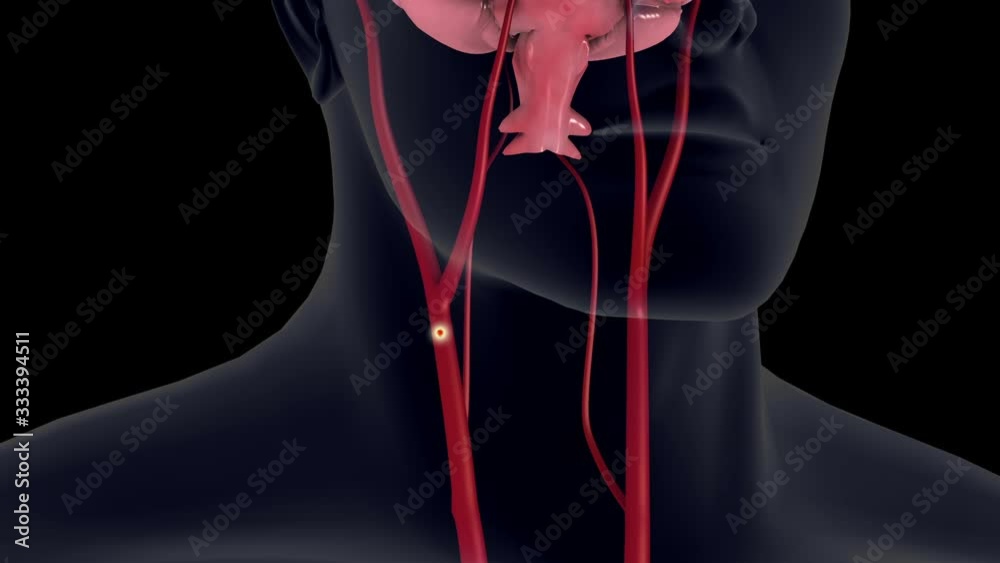 Biomedical animation of an ischemic stroke in the brain.