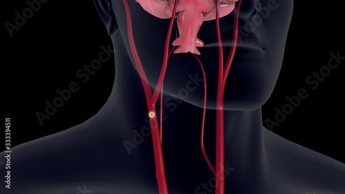 Biomedical animation of an ischemic stroke in the brain.