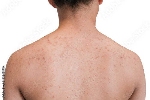Asian teenage girls scratching pimples on the back. With many red spots on the back.