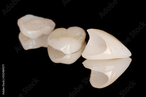 Zahnkrone Veneer aus Vollkeramik