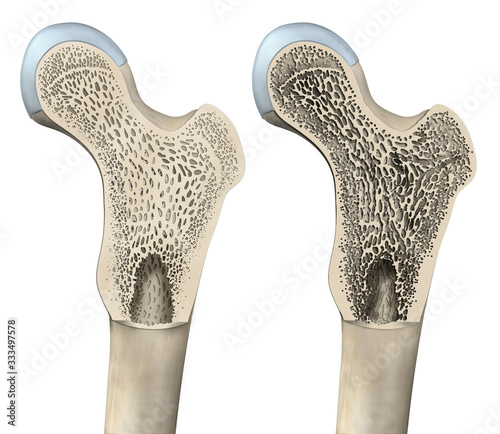 Photos Osteoporosis, healthy femur and osteoporotic femur, 3D illustration