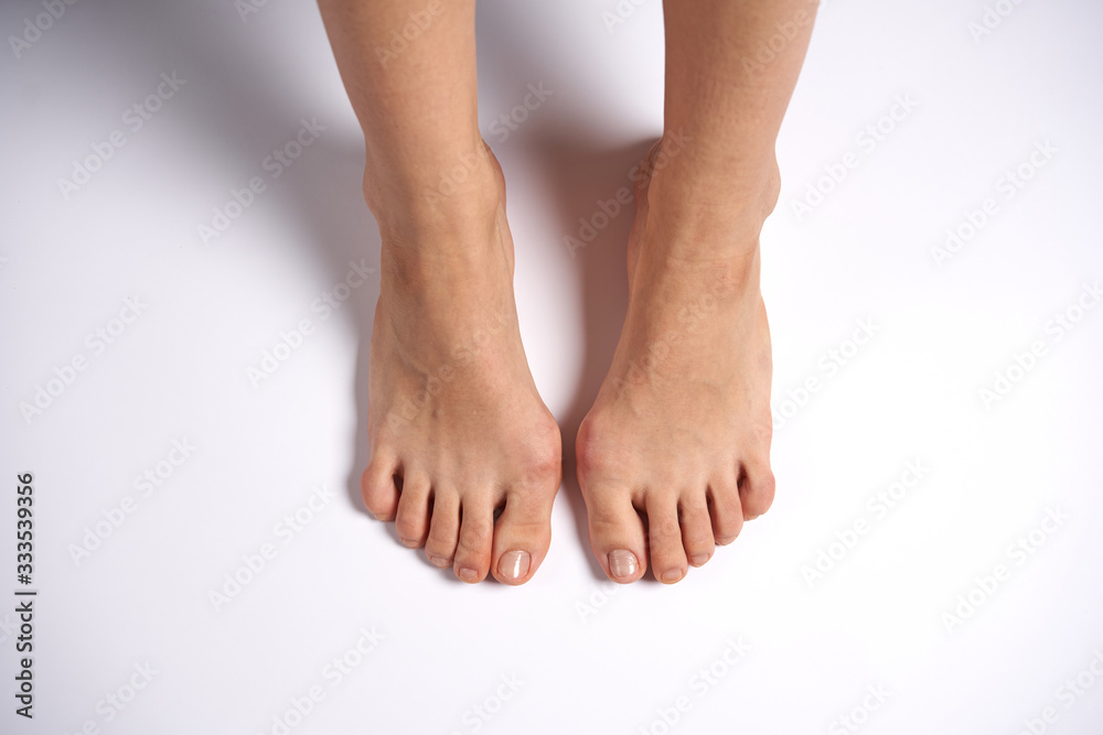 Hllux Valgus on female legs close up solated on white background Hllux Valgus on female legs close up solated on white background