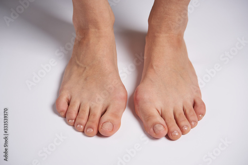 Hllux Valgus on female legs close up solated on white background