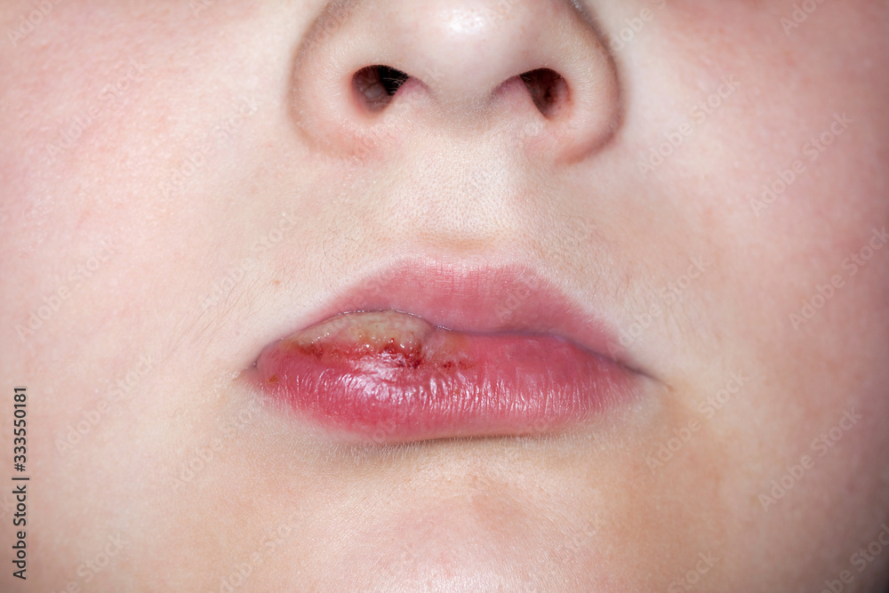 sick boy with big haze on his lips sick boy with big haze on his lips
