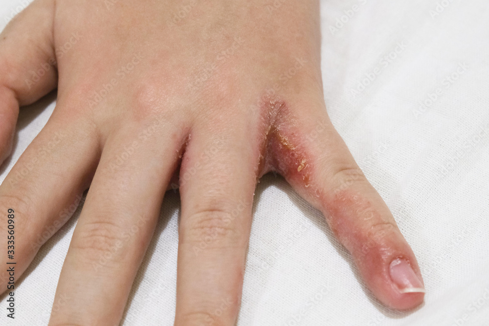 Dyshidrotic Eczema Dyshidrosis Symptoms Causes 52 OFF