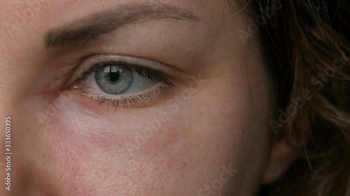 Young girl with an allergic reaction on the face and eyes, Quincke's edema. Swelling of the face from nose to eyes in a young woman. Angioedema close up view photo