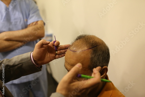 9 January 2014 Istanbul, Turkey. Hair transplantation is a surgical technique that moves hair follicles from a part of the body called .