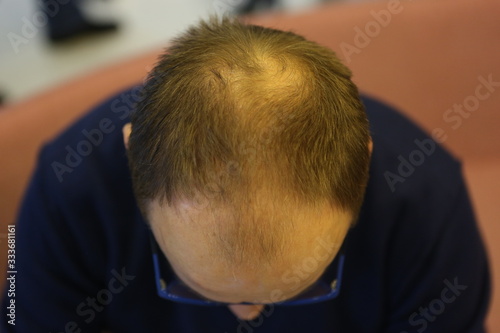 4 December 2014. Istanbul.Turkey. Hair transplantation is a surgical technique that moves hair follicles from a part of the body.