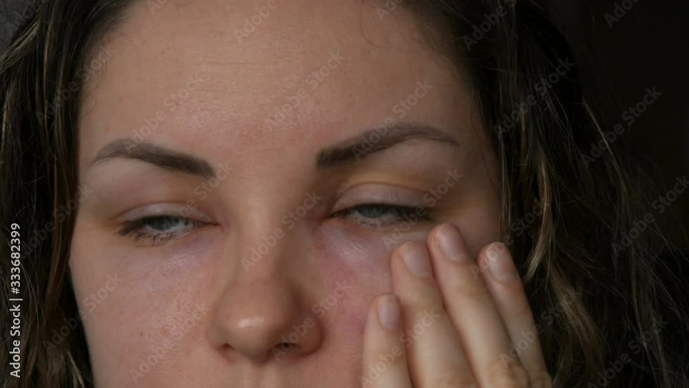 Young girl with an allergic reaction on the face and eyes, Quincke's edema. Swelling of the face from nose to eyes in a young woman. Angioedema, Woman touches her swollen face Young girl with an allergic reaction on the face and eyes, Quincke's edema. Swelling of the face from nose to eyes in a young woman. Angioedema, Woman touches her swollen face