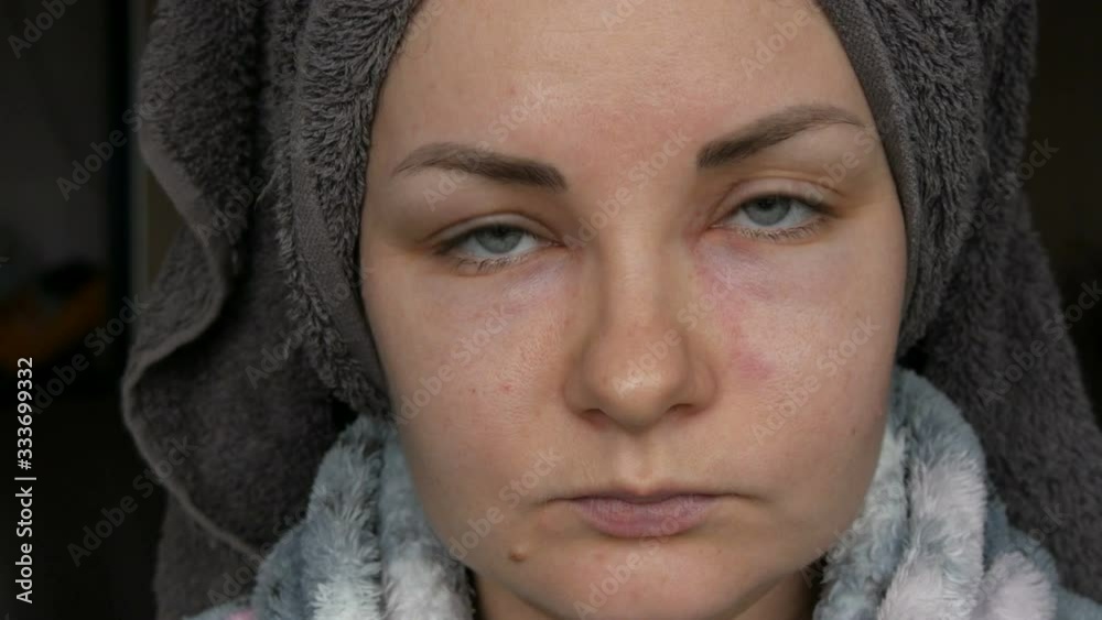 Video Stock Young girl with an allergic reaction on the face and eyes