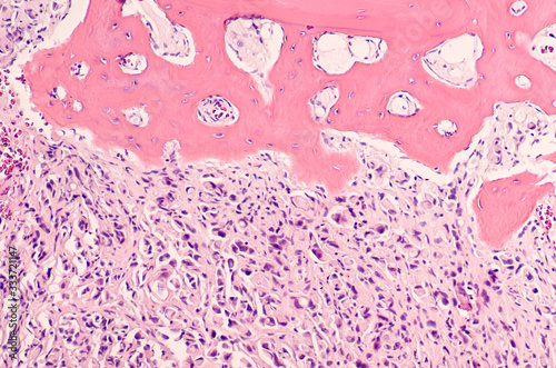 Stomach Cancer; Photomicrograph (microscopic image) of a poorly differentiated (grade 3) gastric adenocarcinoma with metastatic spread to bone.   photo