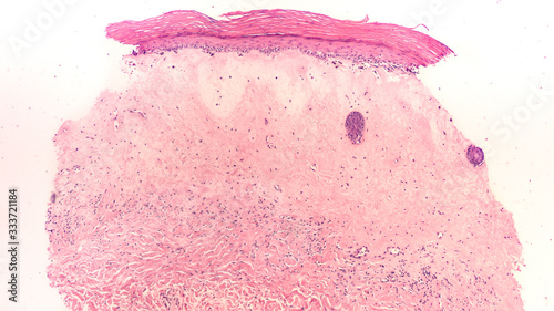 Cuadro en lienzo Microscopic image of lichen sclerosis, which includes lichen sclerosis et atrophicus and balanitis xerotica obliterans, a skin disease of unknown cause, typically on the genitals (vulva or penis)