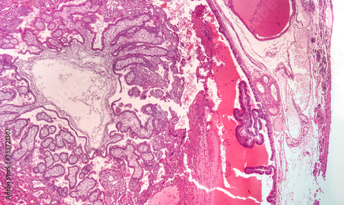 Ectopic pregnancy is a condition in which an embryo attaches outside the uterus, which may cause life threatening hemorrhage.  This micrograph shows chorionic villi (left) within the fallopian tube.   photo