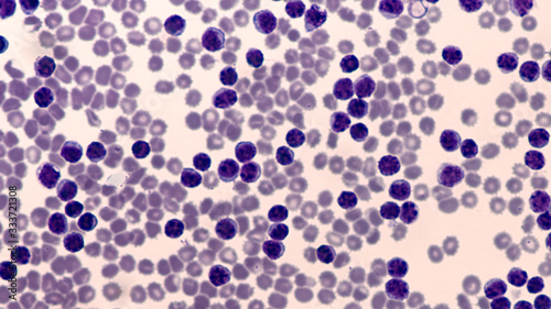 Leukemia Awareness: Photomicrograph of pleural effusion in a patient with chronic lymphocytic leukemia (CLL), which is the same disease as small lymphcytic lymphoma (SLL), a cancer of lymphcytes. 