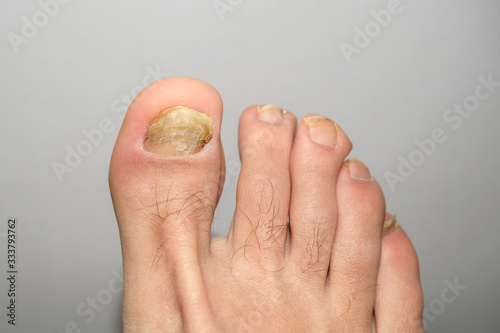 Young guy barefoot fingers with sick onycho mycosis nails,dermatologic medical 