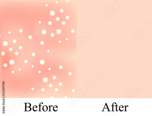 Texture, inflamed pimples and acne. Before After acne. Skin background. Infographics. Vector illustration on isolated background