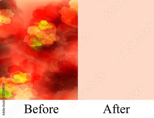 Texture, inflamed pimples and acne. Before After acne cysts. Skin background. Infographics. Vector illustration on isolated background.