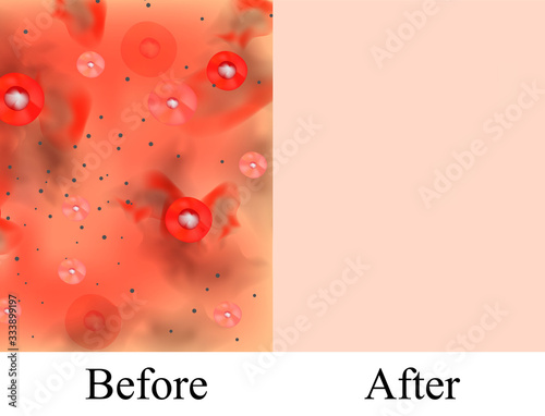 Texture, inflamed pimples and acne. Before After acne cysts. Skin background. Infographics. Vector illustration on isolated background.