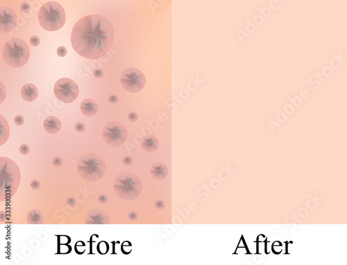 Texture with acne scars and acne. Before After scar cysts. Skin background. Infographics. Vector illustration
