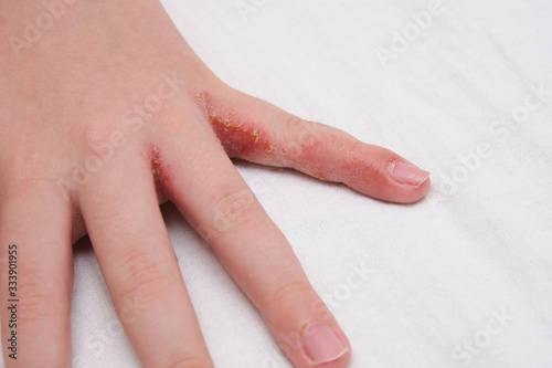 Child hand witn eczema, atopic dermatitis between fingers photo