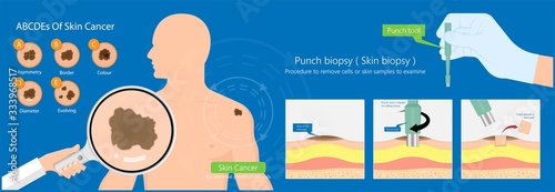 Skin biopsy dermoscope tool surgical diagnose lupus rash cell exam medical Shave Punch dermis layer superficial fat ABCDE rule sign check basal moles treat remove inflammatory tags Warts lab test type