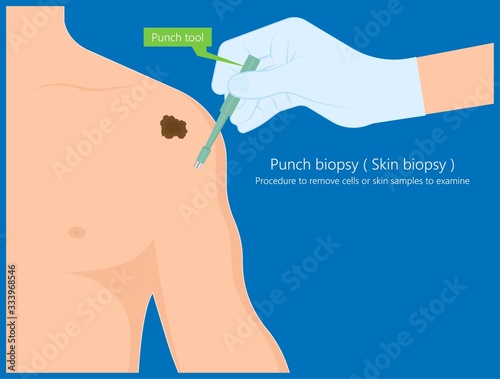Skin biopsy dermoscope tool surgical diagnose lupus rash cell exam medical Shave Punch dermis layer superficial fat ABCDE rule sign check basal moles treat remove inflammatory tags Warts lab test type