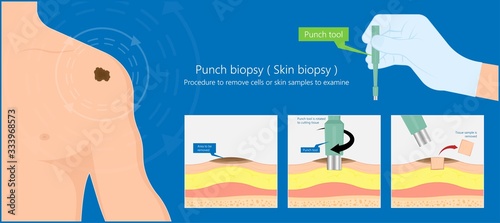 Skin biopsy dermoscope tool surgical diagnose lupus rash cell exam medical Shave Punch dermis layer superficial fat ABCDE rule sign check basal moles treat remove inflammatory tags Warts lab test type photo