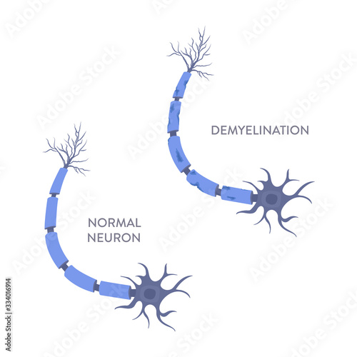 Healthy and damaged neuron diagram. Demyelination of neuron shealth under microscope. Loss of nerve cell myelin caused by multiple sclerosis. Neurological disease. Medical concept. Vector illustration