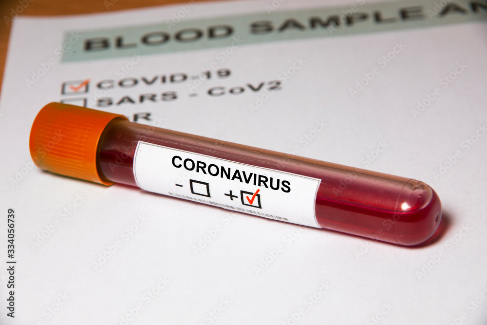 Probeta sobre formulario de resultados de análisis de sangre de Coronavirus o Covid19 Probeta sobre formulario de resultados de análisis de sangre de Coronavirus o Covid19