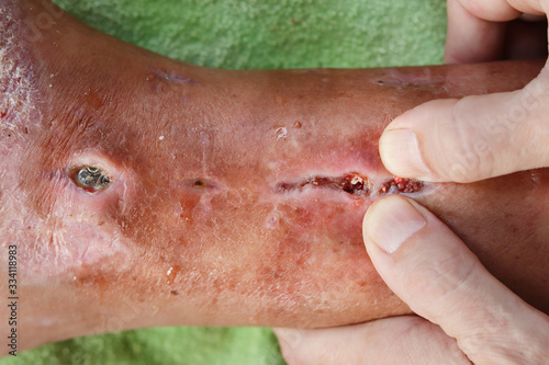 A postoperative wound infection or surgical wound infection on the right foot