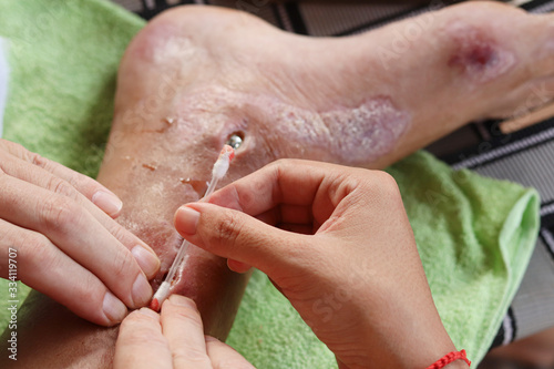 A postoperative wound infection or surgical wound infection on the right foot