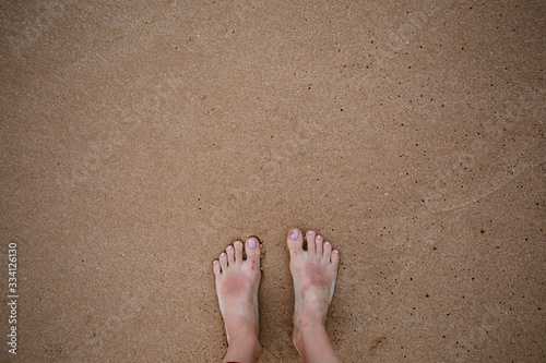 
Burnt feet of a European man on the background of sand on the beach. Consequences of sunburn without using sunscreen