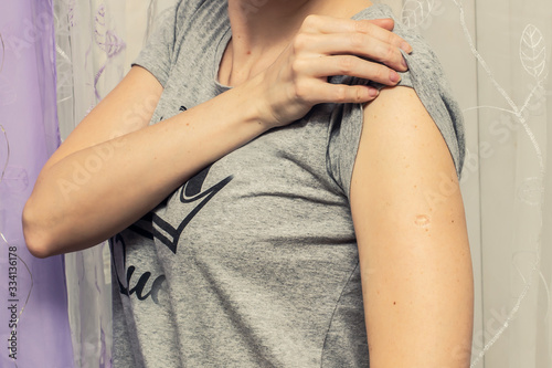 Woman with smallpox following BCG vaccination against TB vaccine