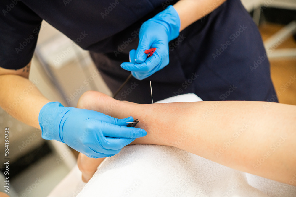 Obraz premium Electro-acupuncture dry with needle connecting machine