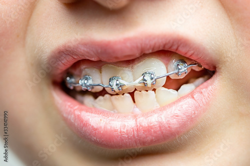 Teeth with orthodontic brackets. Dental health care.