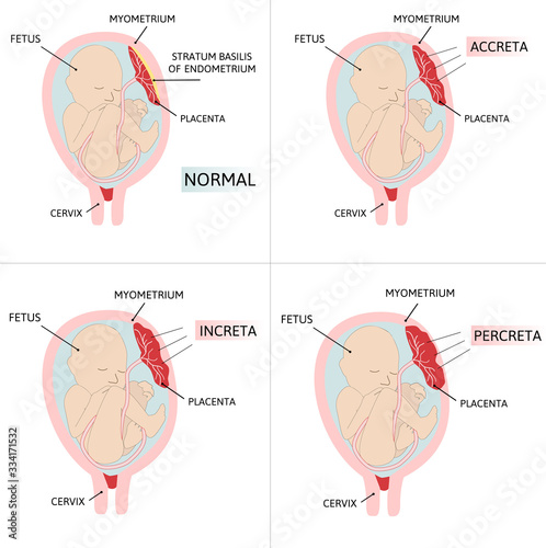Placenta accreta. Accrete, increta, percreta. colored medical photo